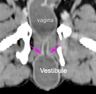 Dog Ct aplasia of the vulva