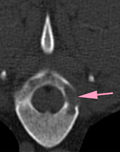 : Dog CT Scan osteolytic lesion in left pedicle