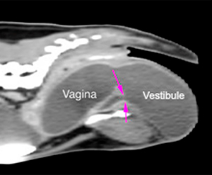 Doc CT scan external urethral orifice
