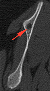 Dog CT lytic lesion in scapula