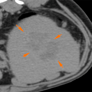Dog CT lesion in caudal aspect of the spleen