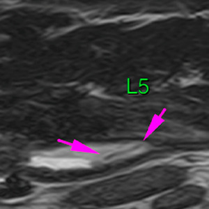 Dog MRI foreign body in left psoas muscle