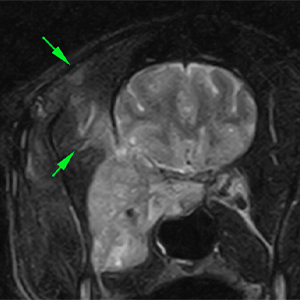 Dog MRI diffuse hyperintensity of the right temporalis muscle