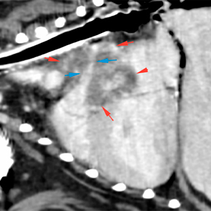 Dog Ct compression of the right pulmonary artery