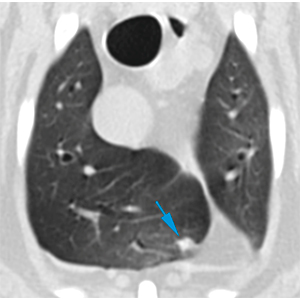 CT canine pulmonary nodules