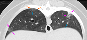 Ct canine ill-defined pulmonary nodules