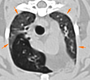 lung, bronchial walls, cat, CT
