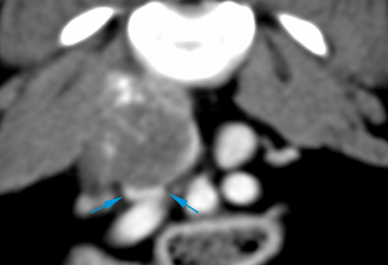 canine CT vascular displacement and compression