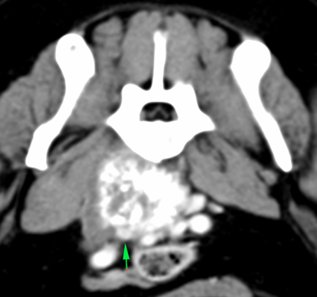 canine CT embedded vein into the mass