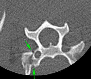 canine CT transverse process C6 fracture