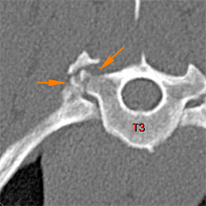 canine CT transverse process T3 fracture