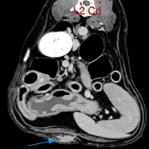fistula, thoracic and abdominal wall, dog, CT