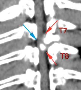 canine CT extradural extension thoracic spine mass