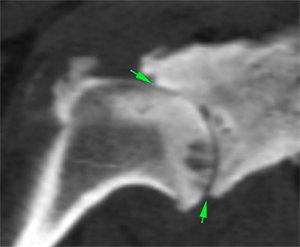 canine CT shoulder joint collapse