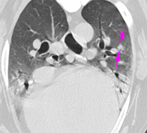 canine CT pulmonary metastatic nodule