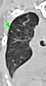 cat CT pulmonary nodules