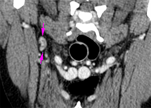 canine CT right axillary lymphadenomegaly