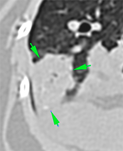 cat CT ill-defined pulmonary nodule mineral foci