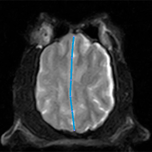 MRI, midline shift, transtentorial herniation, cerebellar herniation