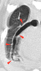 feline CT cylindrical bronchiectasis