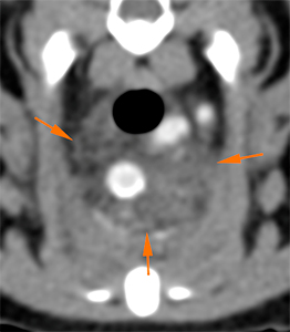 feline CT mediastinal thickening with effacement of fat attenuation