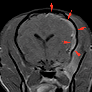 meningeal thickening, subdural empyema, dog, MRI