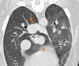 canine CT pulmonary metastasis