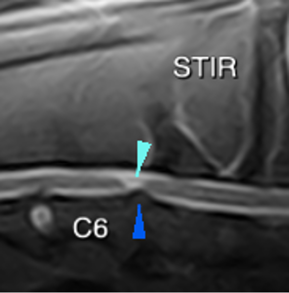 dog, MRI, cervical spine, intramedullary lesion, spinal cord