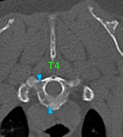 Dog, thoracolumbar spine, vertebra