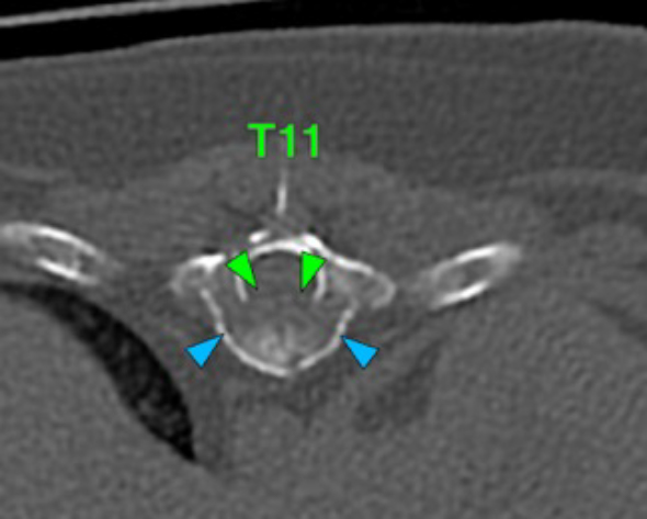 Dog, thoracolumbar spine, vertebra