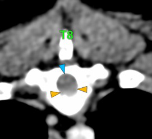 Dog, thoracolumbar spine, vertebra