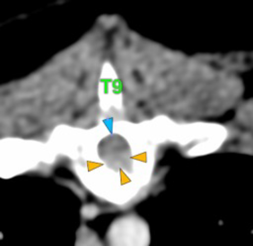 Dog, thoracolumbar spine, vertebra