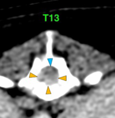 Dog, thoracolumbar spine, vertebra