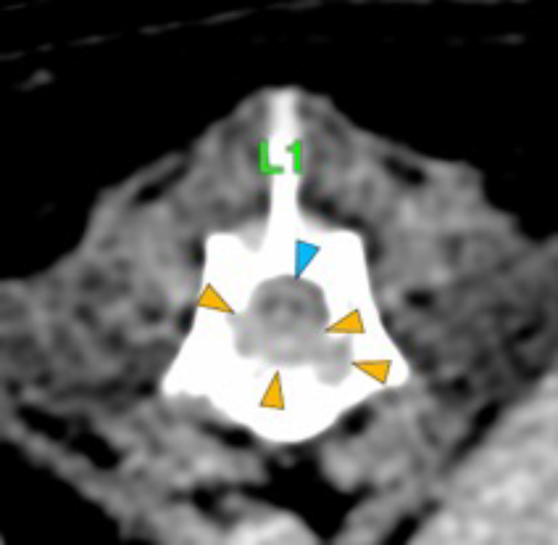 Dog, thoracolumbar spine, vertebra