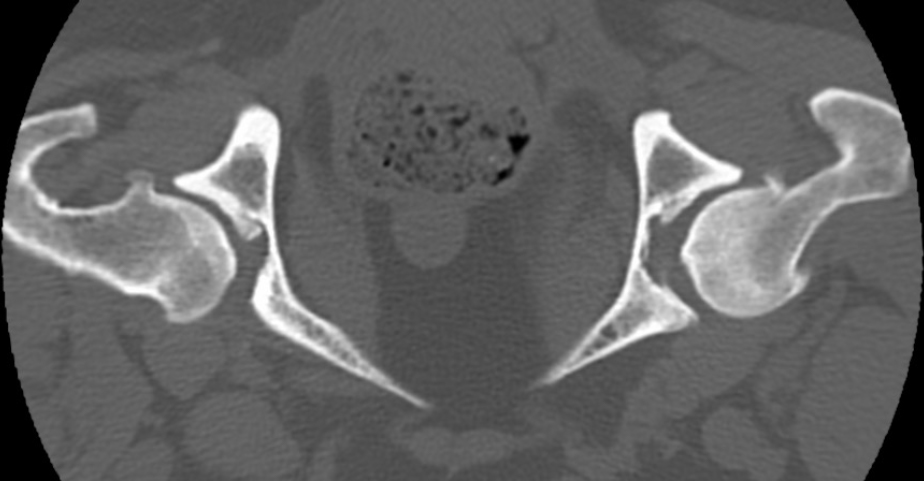 dog, CT, thoracolumbar spine, femoral heads and necks